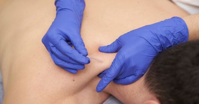 Can Dry Needling Help With Chronic Pain? 